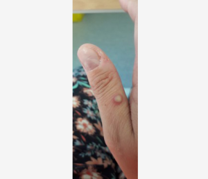 Monkeypox Rash